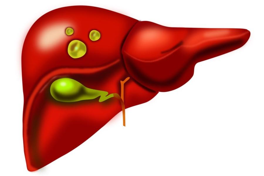 Jautājam speciālistam. Cista aknā, vai satraukties?