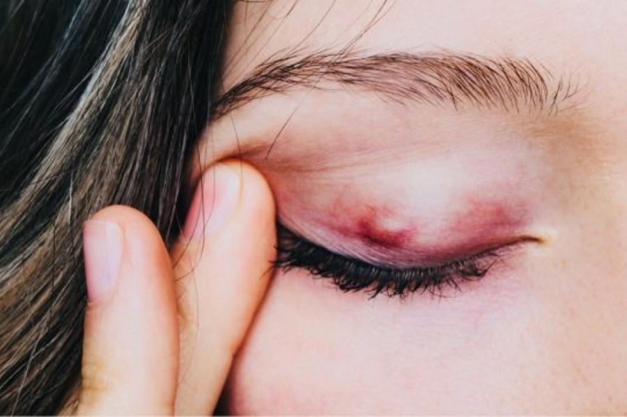 Kā cīnīties ar mieža graudu? Jautājam speciālistam