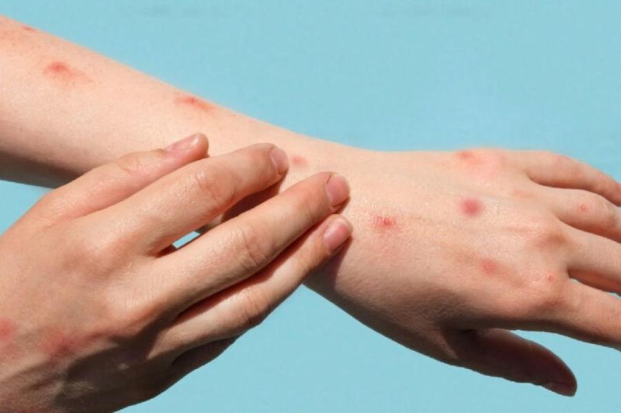 Latvijā ziņo par zāļu blaknēm: izsitumi, dermatīts, alerģijas (+VIDEO)